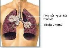 Lung Cancer Screening in the Occupational Setting – An Update